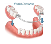 partial dentures - Dentures and Partial Dentures