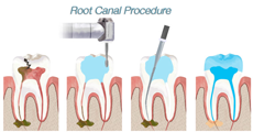 rootcanalprocedure - Root Canals