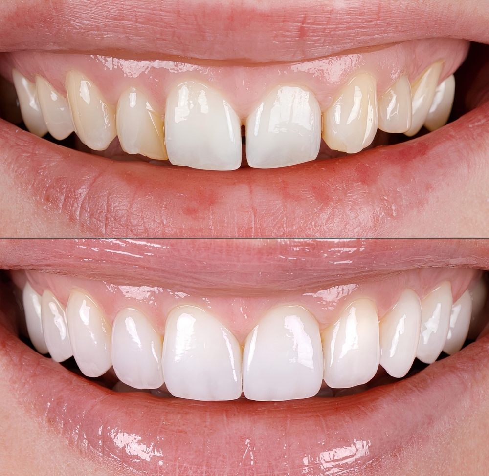 Aesthetic smile design treatment in dental dentistry. E-Max and zirconium porcelain crowns. S