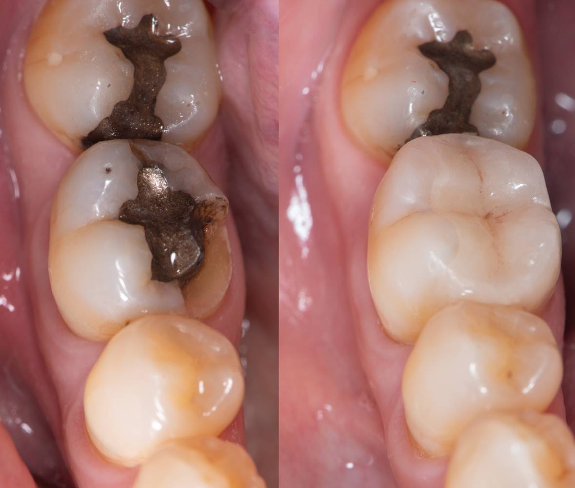 Dental collage, closeup of teeth before and after dental ceramic onlay treatment.