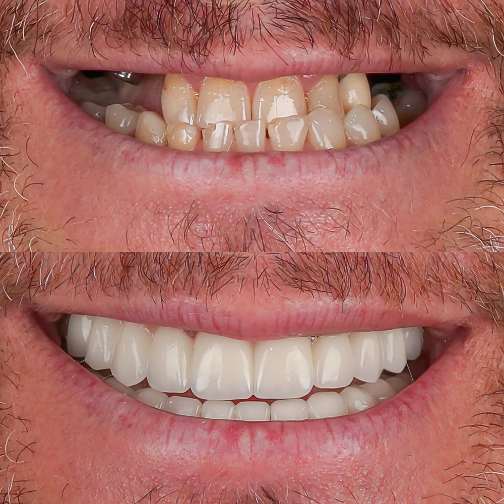 Full jaw dental prosthesis in people with no teeth. Dental implant treatment all-on-four, all-on-X, and all-on-4 implant treatment before and after intraoral photo of full jaw hybrid dental prosthesis