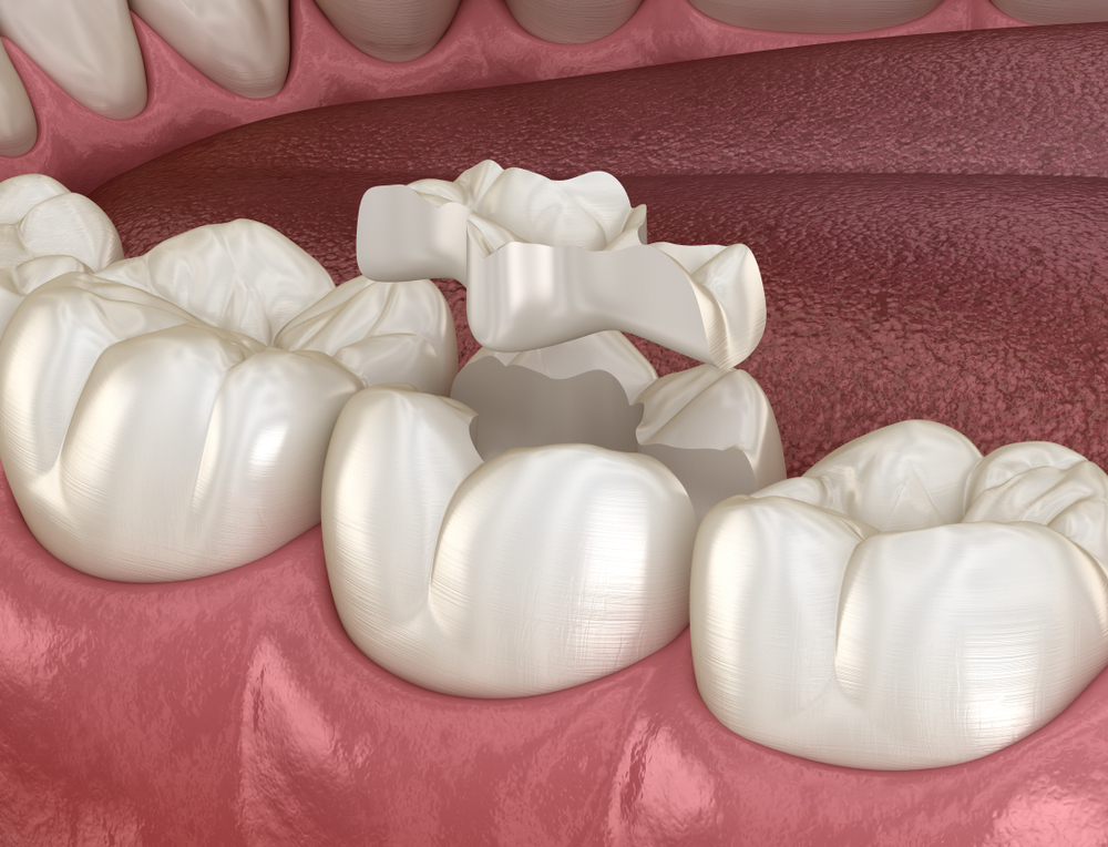 Inlay ceramic crown fixation over tooth. Medically accurate 3D illustration of human teeth treatment