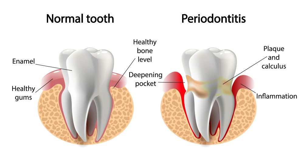 vector image tooth disease
